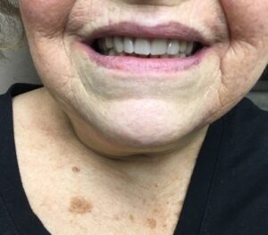 dentures-for-seniors-in-ingersoll