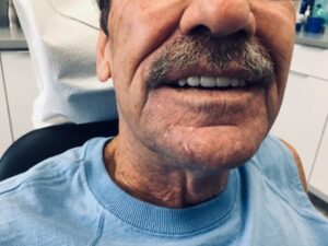 dentures-for-seniors-in-ontario