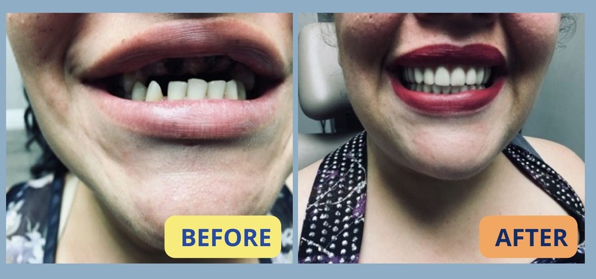 Before and after dentures in Guelph – case 1: patient with missing and broken upper teeth, then smiling with a full new denture