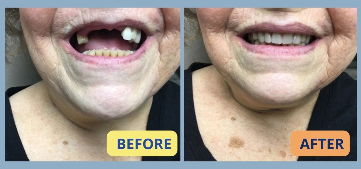 Before and after dentures in Guelph – case 2: missing upper teeth restored with a natural-looking denture